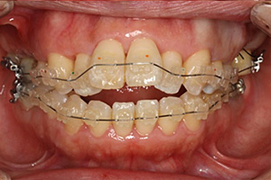 矯正治療の症例01 矯正中