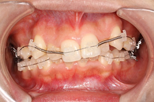 歯周病治療の症例02 矯正中