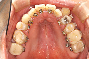 歯周病治療の症例04 矯正中