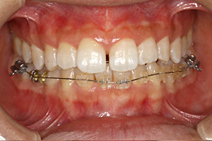 歯周病治療の症例04 矯正中