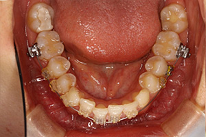 歯周病治療の症例04 矯正中