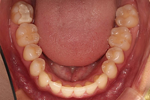 歯周病治療の症例04 矯正後