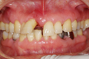 歯周病治療の症例03 術前