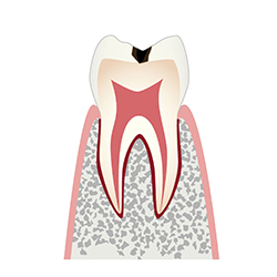 虫歯レベル1（C1）