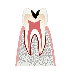 虫歯レベル2（C2）