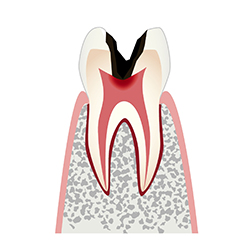 虫歯レベル3（C3）