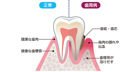 自覚症状がないまま進行してしまう歯周病