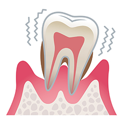 その4 ＜歯根まで到達した細菌によって歯が抜けてしまう＞